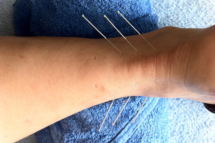 acupuncture